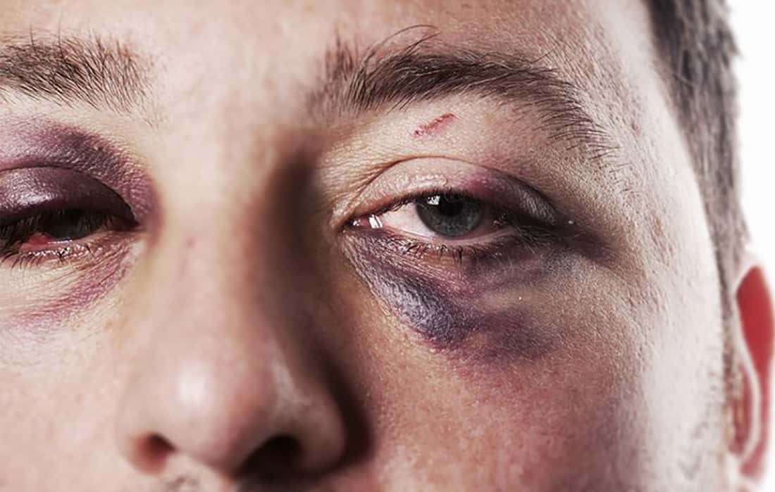 blackeye-1526604819874.jpg