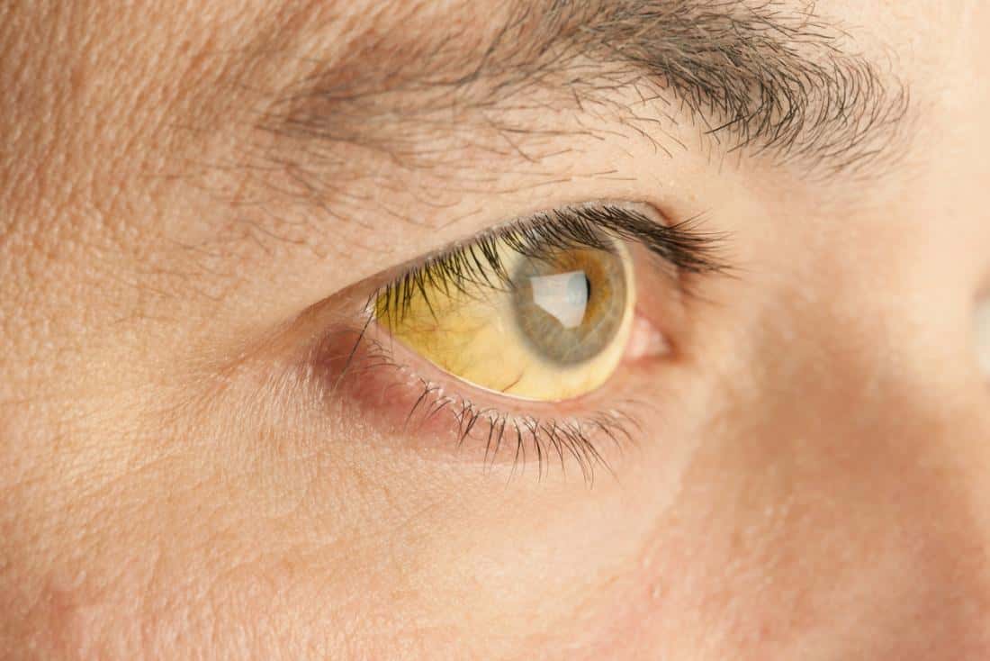 jaundice-eye-1527225051456.jpg