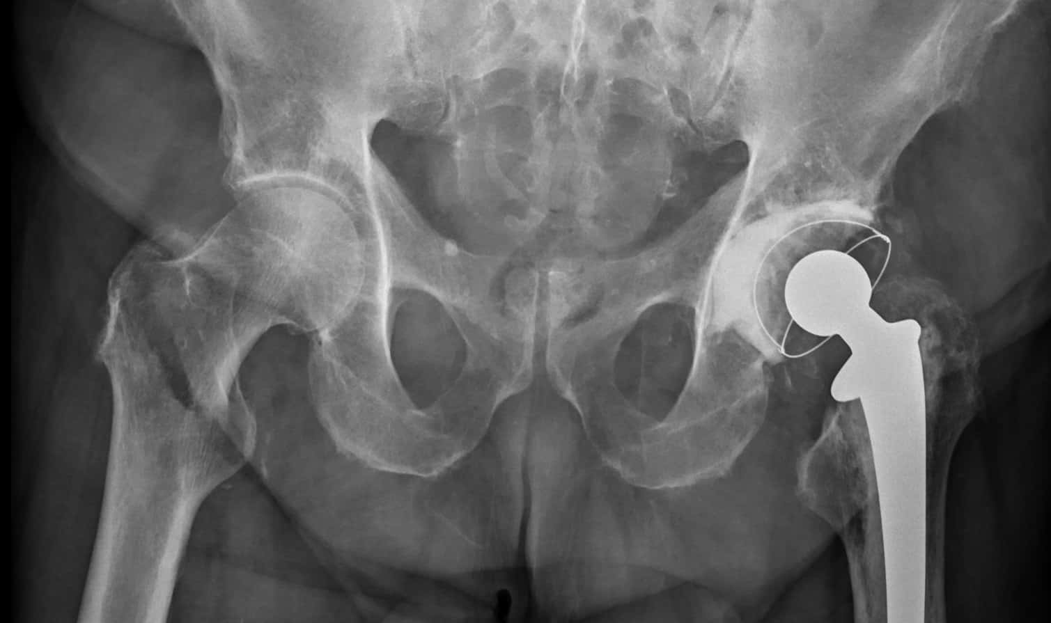 skin_folds_over_a_hip_fracture-1558044524519.jpg