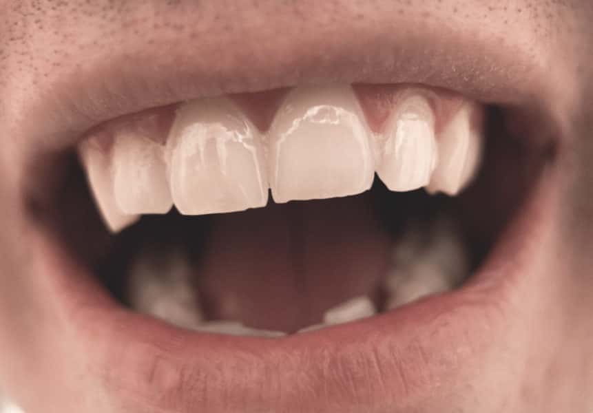 mouth-and-teeth-close-up-861x600-1564706561593.jpg