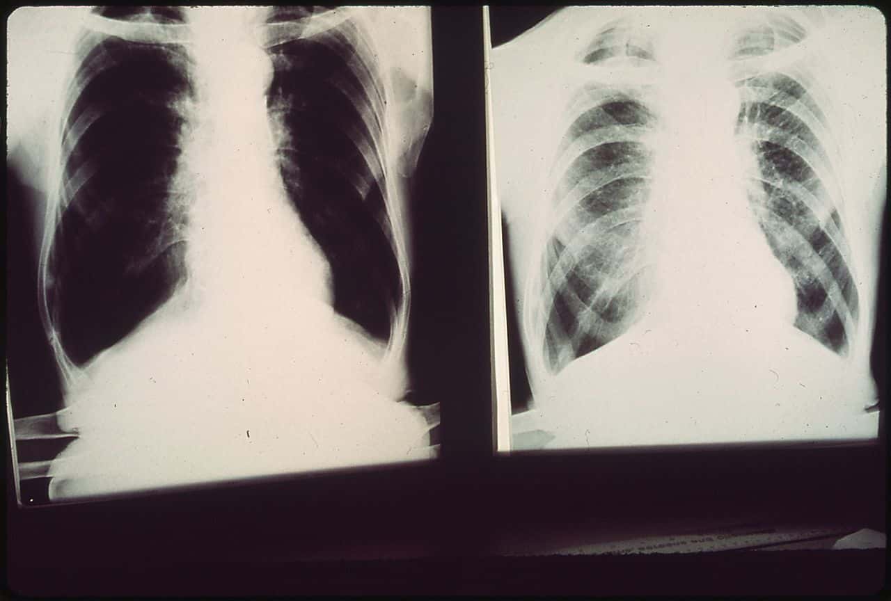 1280px-BLACK_LUNG_X-RAYS_FROM_PATIENTS_OF_DR._A.H._RUSSAKOFF_PULMONARY_DISEASE_SPECIALIST_AND_PIONEER_AIR_POLLUTION_FIGHTER..._-_NARA_-_545474