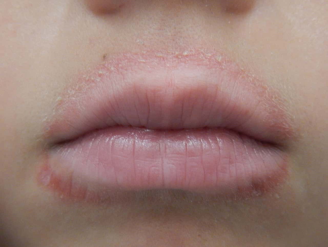 1280px-Lip_licker's_dermatitis
