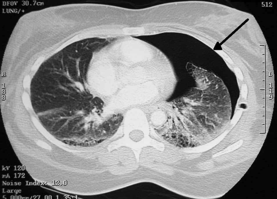 Pneumothorax_CT