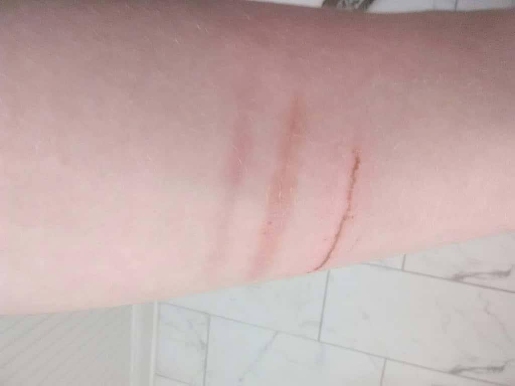 768px-Self-injury_cuts_and_scars_on_forearm