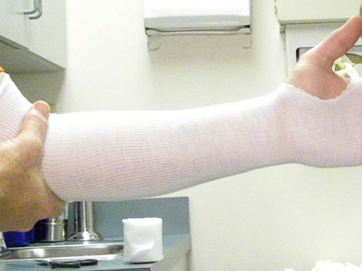 Getting_A_Cast_On_His_Arm