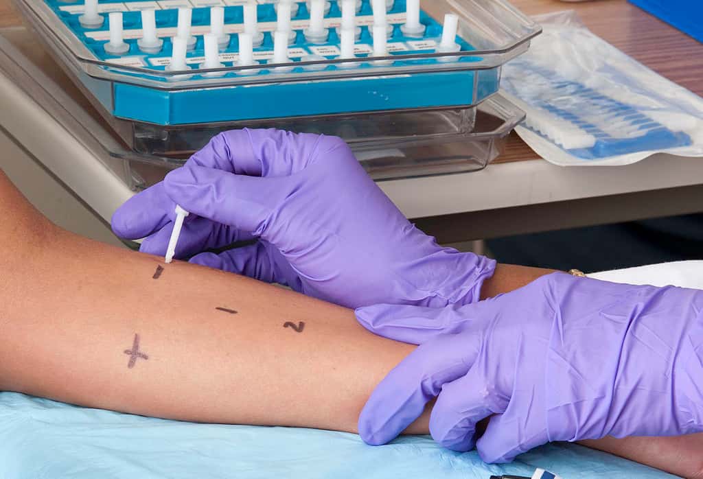 Skin_prick_testing_for_allergies