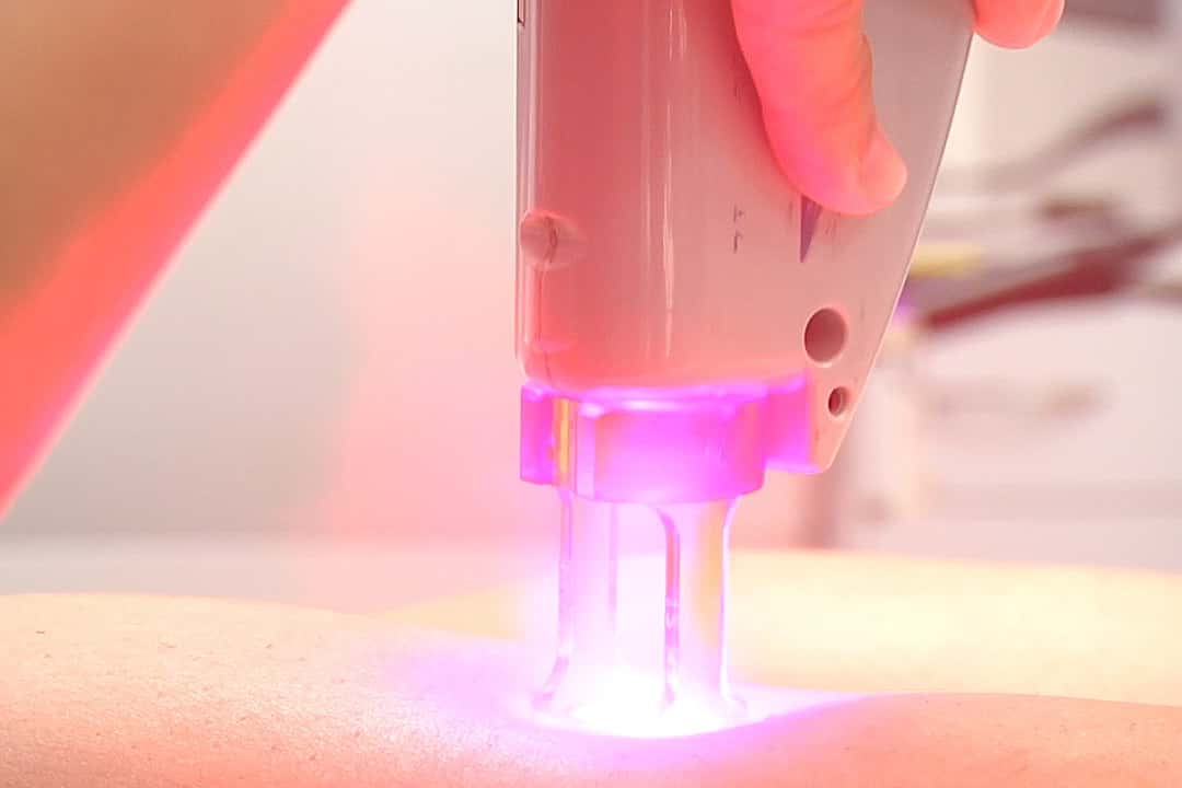 1280px-Laser-hair-removal-legs-2-ama-regenerative-medicine