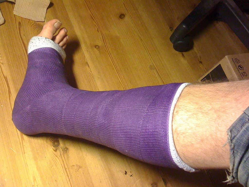 1024px-Short_leg_cast