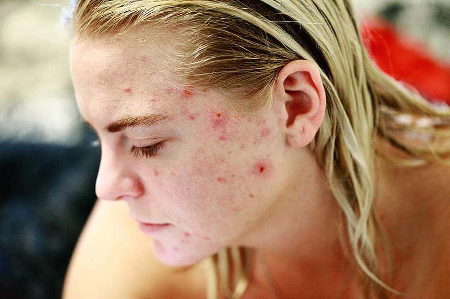 struggle-acne-self-love-skin-face-portrait-woman-people-reality