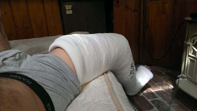 First_plaster_long_leg_cast...._-_9386353868