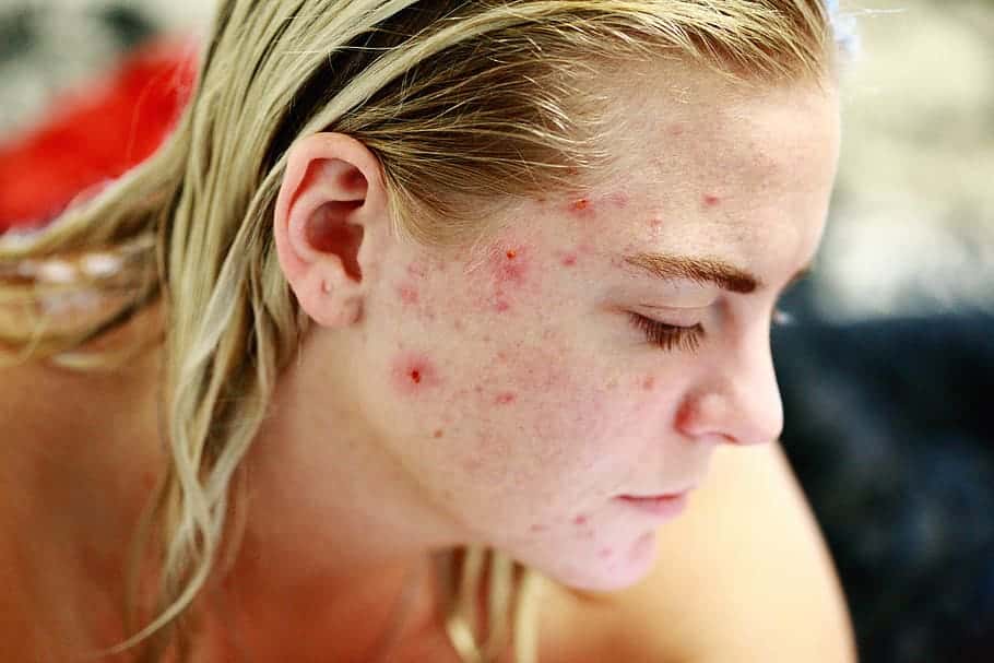 struggle-acne-self-love-skin